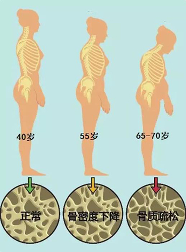 骨密度检测仪可以告诉你，你的骨质是否在遗失
