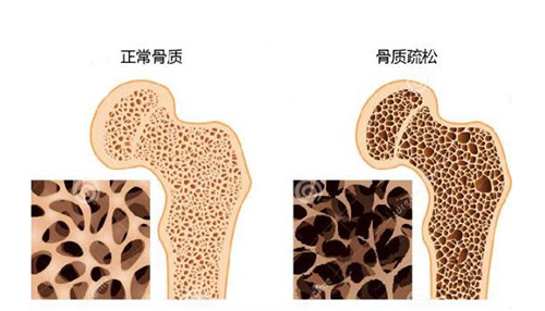 【骨密度仪厂家】因血糖升高而导致的骨质疏松该如何预防