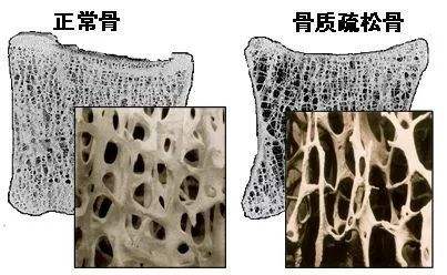骨密度仪对于骨质疏松症具有良好的跟踪预防作用