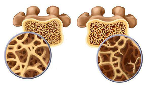 【骨密度仪】骨质疏松症的治疗不能只依靠补钙
