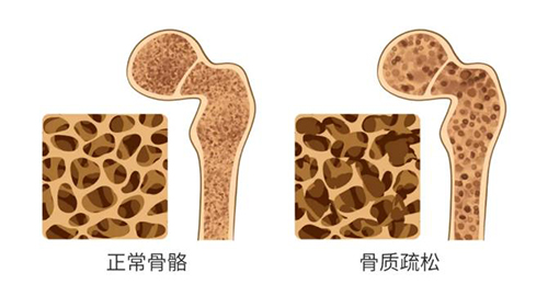 骨密度仪厂家：“口重”的老年人尤其要注重骨质疏松症的预防