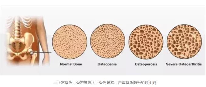 骨密度检测仪提示，合适的锻炼方法及生活方式能减少骨质疏松发病率