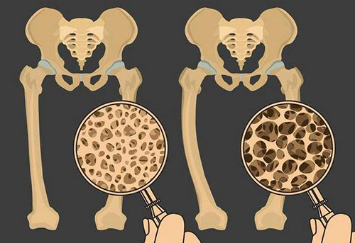 骨密度检测方式到底该如何选？