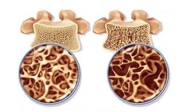 骨密度仪厂家：骨质疏松的不可控因素和可控因素