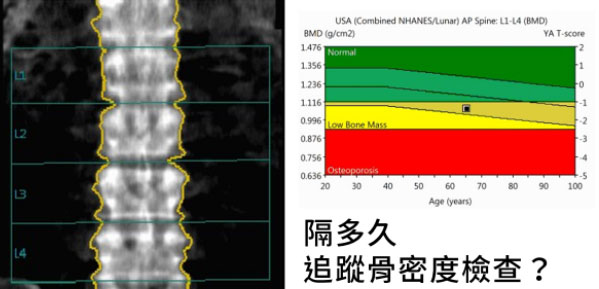 隔多久做一次骨密度检测?