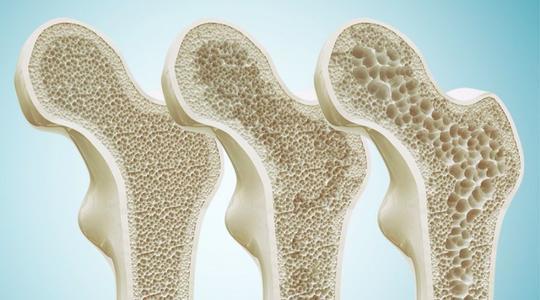 骨质疏松症，可通过骨密度检测仪来测定骨密度