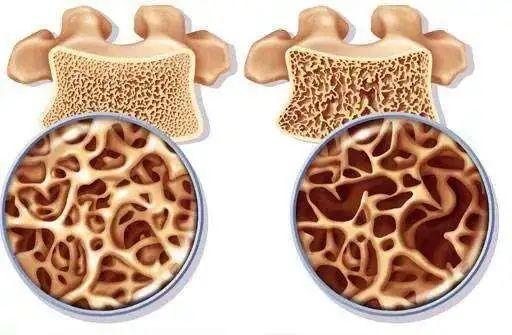 骨密度仪：骨重建障碍将导致骨质疏松症