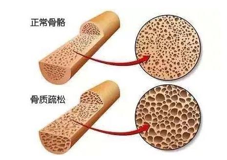 骨密度仪检测仪为你纠正有关骨质疏松的两个误区