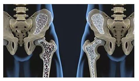针对老年人骨密度检测仪检查出现骨密度降低的该如何养护